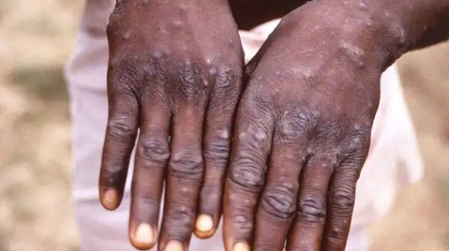 People vaccinated against smallpox likely safe from monkeypox, says specialist
